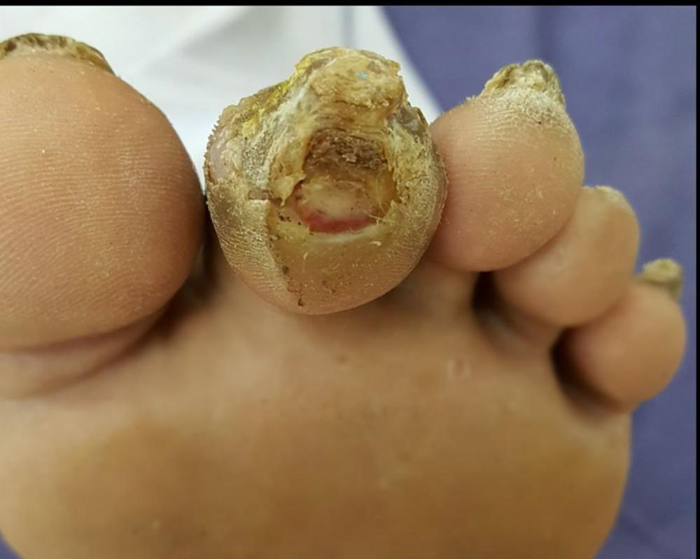 Diabetic Foot Treatment