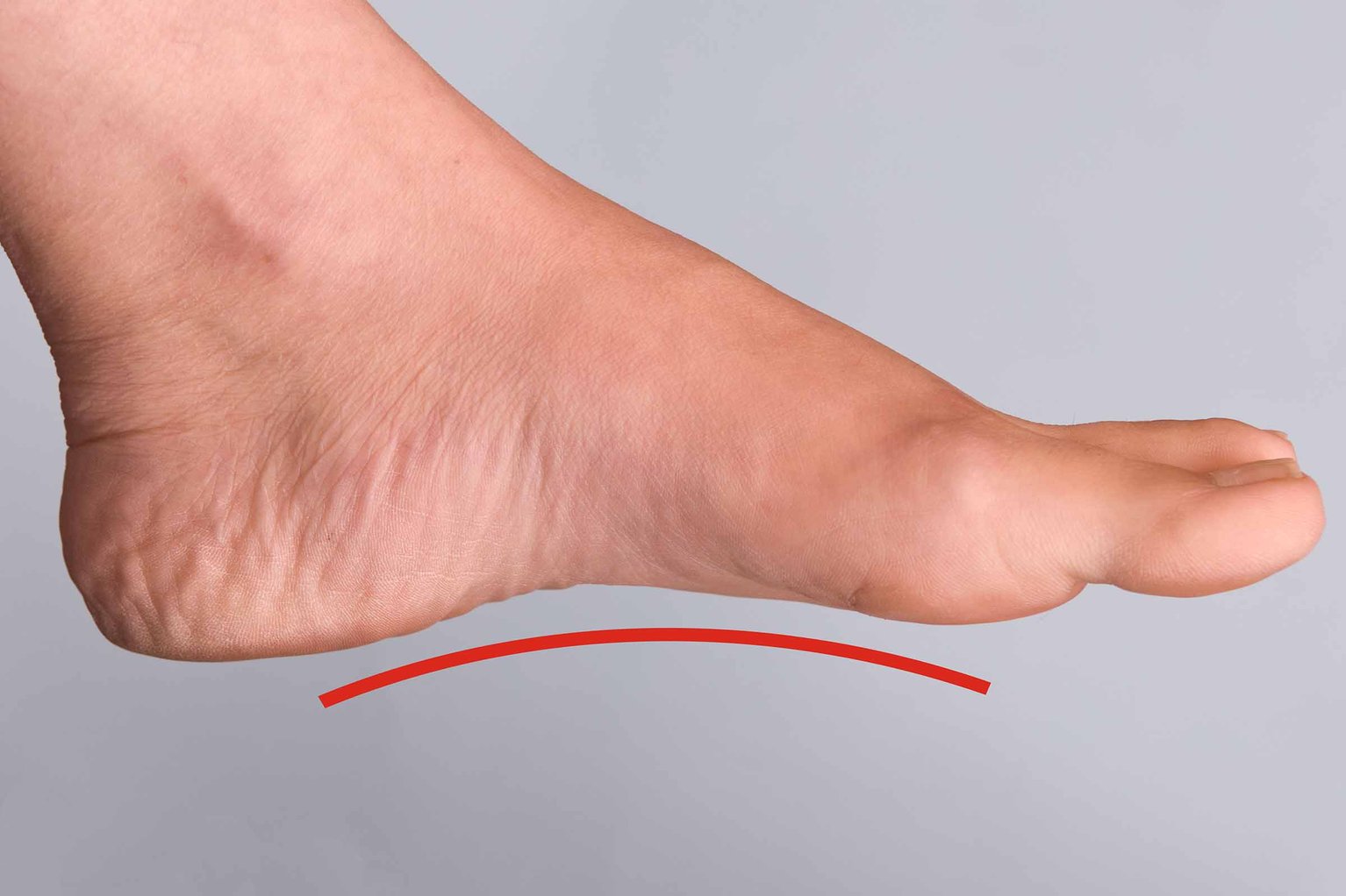 Flat Feet Correction