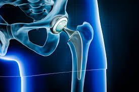 Total Hip Replacement