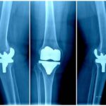 Prosthetic knee joint on roentgenogram - collage