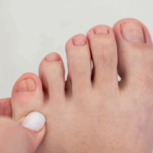 Foot and Toes Deformities